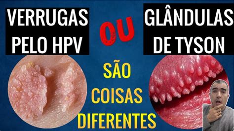 Glândulas de Tyson: o que é, causas e sintomas